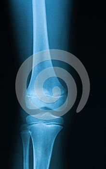X-ray image of knee joint.