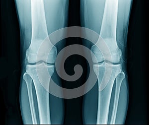 X-ray image of knee joint