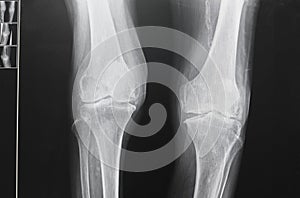 X ray image of knee. X-ray of the knee joint