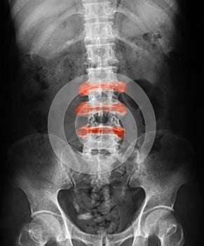 X-ray image of L-S spine, AP view.