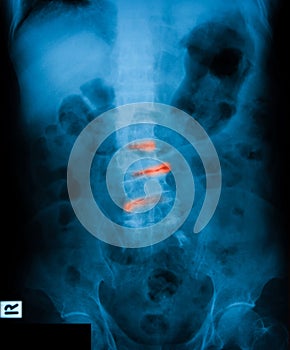 X-ray image of L-S spine, AP view.