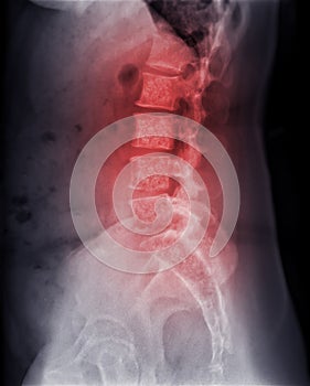 X-ray image of lambosacral spine or L-S spine showing Bone metastasis
