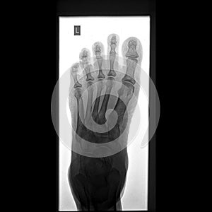 X-ray image of left foot Ap view