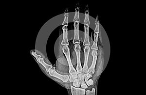 X-ray image of left hand show fracture at little finger phalanxes