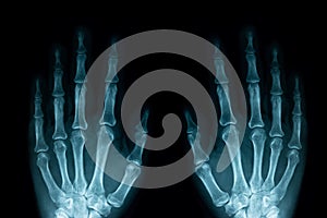 X-ray image of left and right human hands
