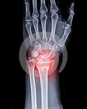 X-ray image of Left wrist joint AP and Lateral view for showing fracture of radius bone