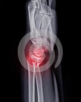 X-ray image of Left wrist joint AP and Lateral view for showing fracture of radius bone