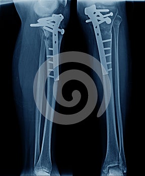 X-ray image of leg show tibia bone fixation