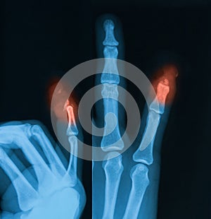 X-ray image of little finger fracture.