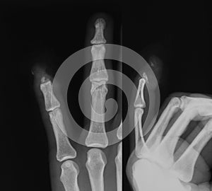 X-ray image of little finger fracture.