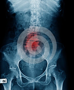 x-ray image of lower back show lumbar spodylosis