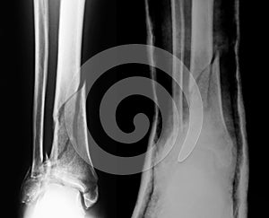 X-ray image of lower leg