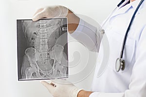 X-ray image of LS spine, AP view, show ankylosing spondylitis lumbar, Doctor examining a lung radiography, Doctor looking chest x-