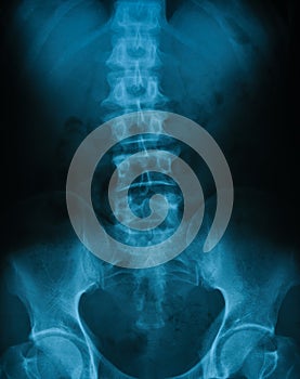 X-ray image of lumbar spine, AP view.