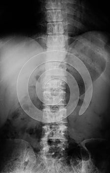 X-ray image of lumbar spine infraction, AP view.