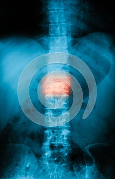 X-ray image of lumbar spine infraction, AP view.