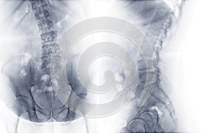 X-ray image of lumbar Spine  or L-s spine AP and lateral view for diagnosis lower back pain