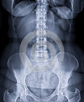 X-ray image of lumbar Spine  or L-s spine front view for diagnosis lower back pain