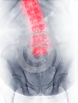 X-ray image of lumbar Spine  or L-s spine Front view showing scoliosis