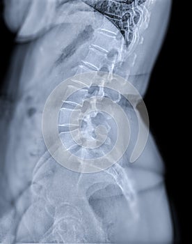 X-ray image of lumbar Spine  or L-s spine lateral view for diagnosis lower back pain