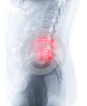 X-ray image of lumbar Spine  or L-s spine lateral view for diagnosis lower back pain