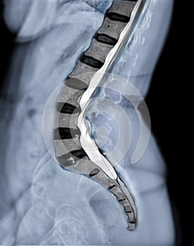 X-ray image of lumbar Spine  or L-s spine lateral view with MRI  l-s spine  for diagnosis lower back pain