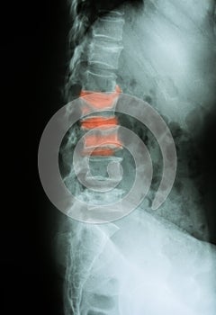 X-ray image of lumbar spine(L-spine), lateral view.