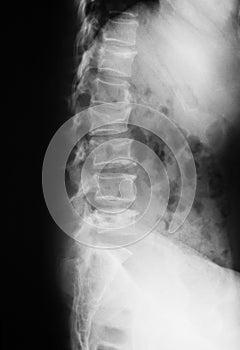 X-ray image of lumbar spine(L-spine), lateral view. showing com