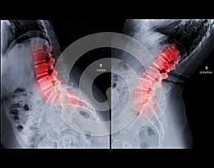 X-ray image of lumbar Spine lateral Flexion and Extension  view showing lower back pain