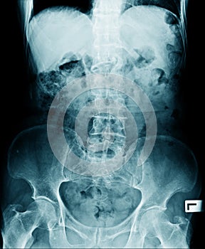 X-ray image of lumbo sacral