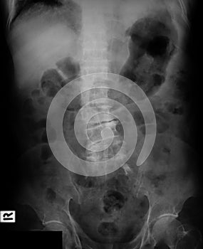 X-ray image of Lumbosacral (L-S) spine, AP view.