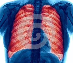 X-Ray Image of Lung infection.