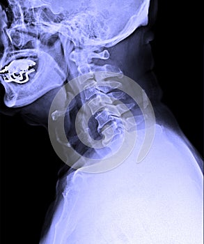 X-Ray image of male human cervical spine