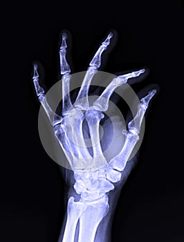 X-Ray image of male human left hand