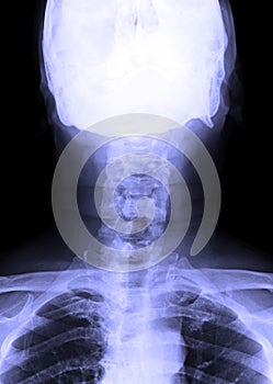 X-Ray image of male human neck