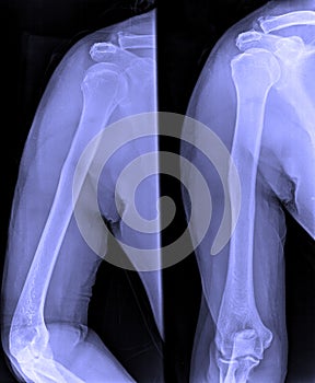 X-Ray image of male shoulder and joints
