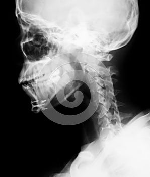 X-ray image of mandible, lateral view.