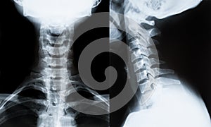 X-ray image of neck