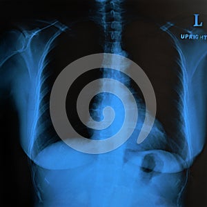 X-ray image of normal woman breast