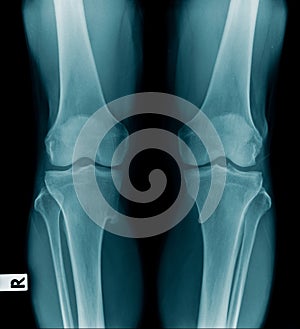 X-ray image OA knee