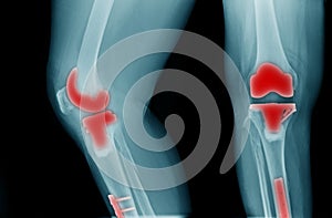 X-ray image of OA knee with banner design