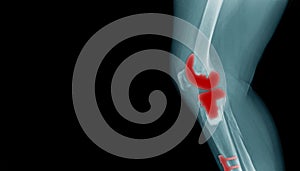 X-ray image of OA knee with banner design