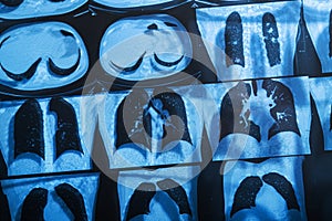 X-ray image of a patient with pneumonia