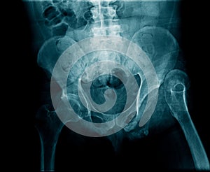 X-ray image pelvic bone and hip joint