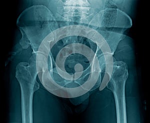 X-ray image pelvic bone and hip joint