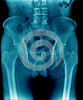 X-ray image pelvic bone and part of femur, spine