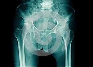 X-ray image pelvic bone and part of l-spine with compression of spine