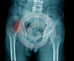 X-ray image of pelvic bone and show avascular necrosis at hip