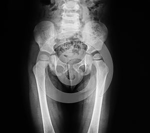 X-ray image of pelvic and hip, AP view.