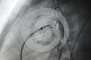 X ray image perform PDA device closure after treatment patent ductus arteriosus disease PDA photo